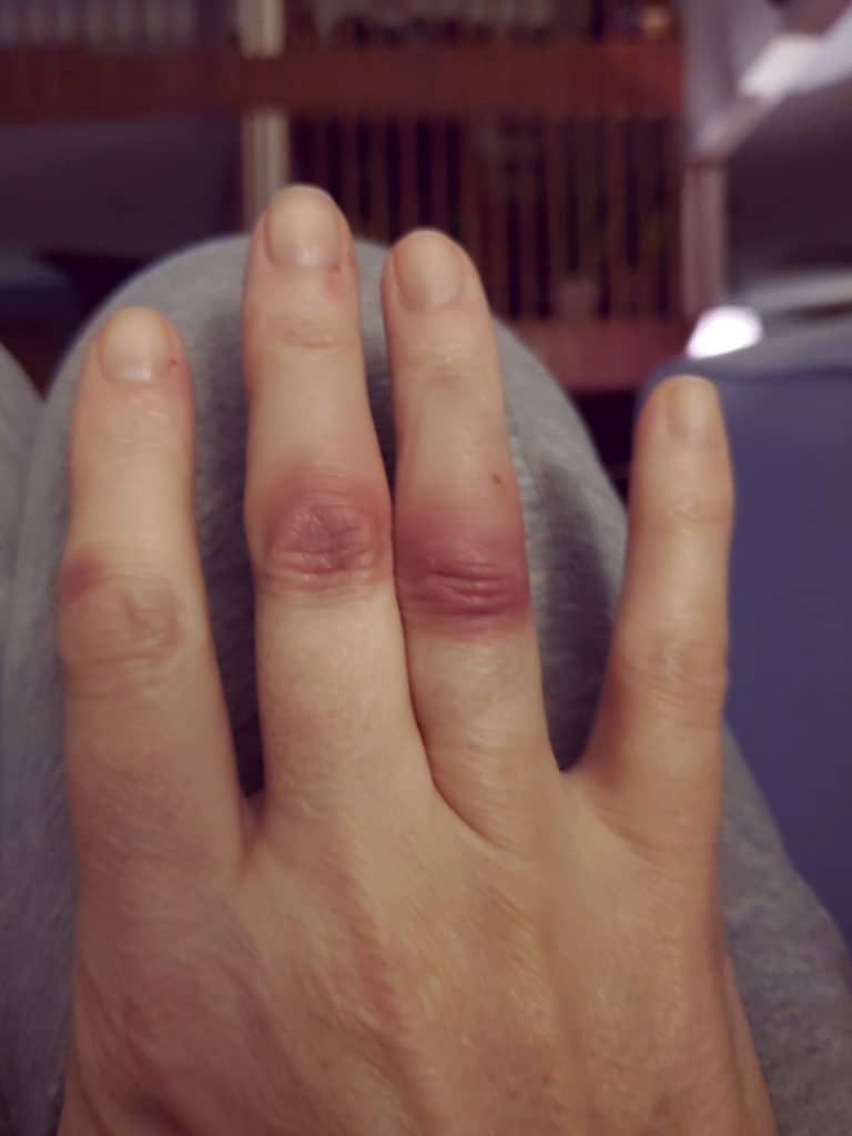 busted up hand after hitting a tree